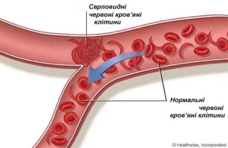 серповидно-клітинна анемія, еритроцити, гемоглобін S