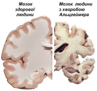 хвороба Альцгеймера, гени, генетика, мозок