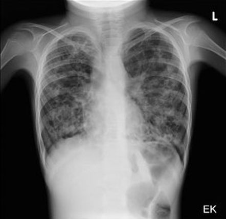 Рентгенограма 12-річного хлопчика із гарячкою  та виділенням харкотиння. Знімок показує масивні центральні бронхоектазії із розвитком вторинного інфікування.
