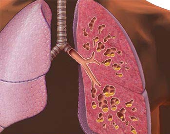 Муковісцидоз легенева форма обструкція дихальних шляхів кістозний фіброз
